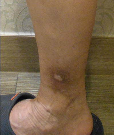대복재정맥 역류 수술 후 회복된 피부 궤양 모습