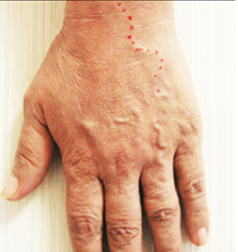 혈관경화요법 치료 전 돌출된 손등 혈관 모습