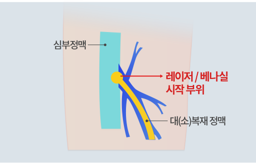 하지정맥류 재발 방지를 위해 레이저 또는 베나실로 혈관 밑동부터 폐쇄하는 치료 방법