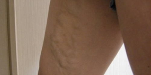 하지정맥류 재치료를 위해 내원한 당시 허벅지 혈관 모습