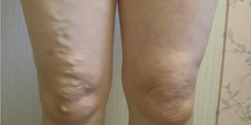 하지정맥류 재치료를 위해 내원한 당시 무릎 주변 혈관 모습
